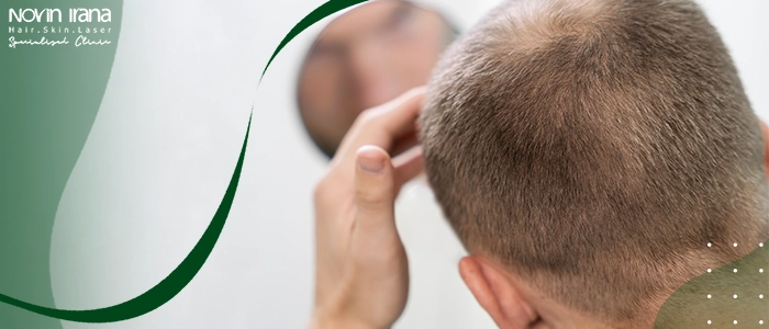 بایدها و نبایدهای کاشت مو برای افراد دیابتی